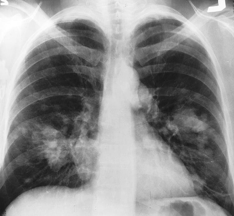 X-ray of lungs with white spots
