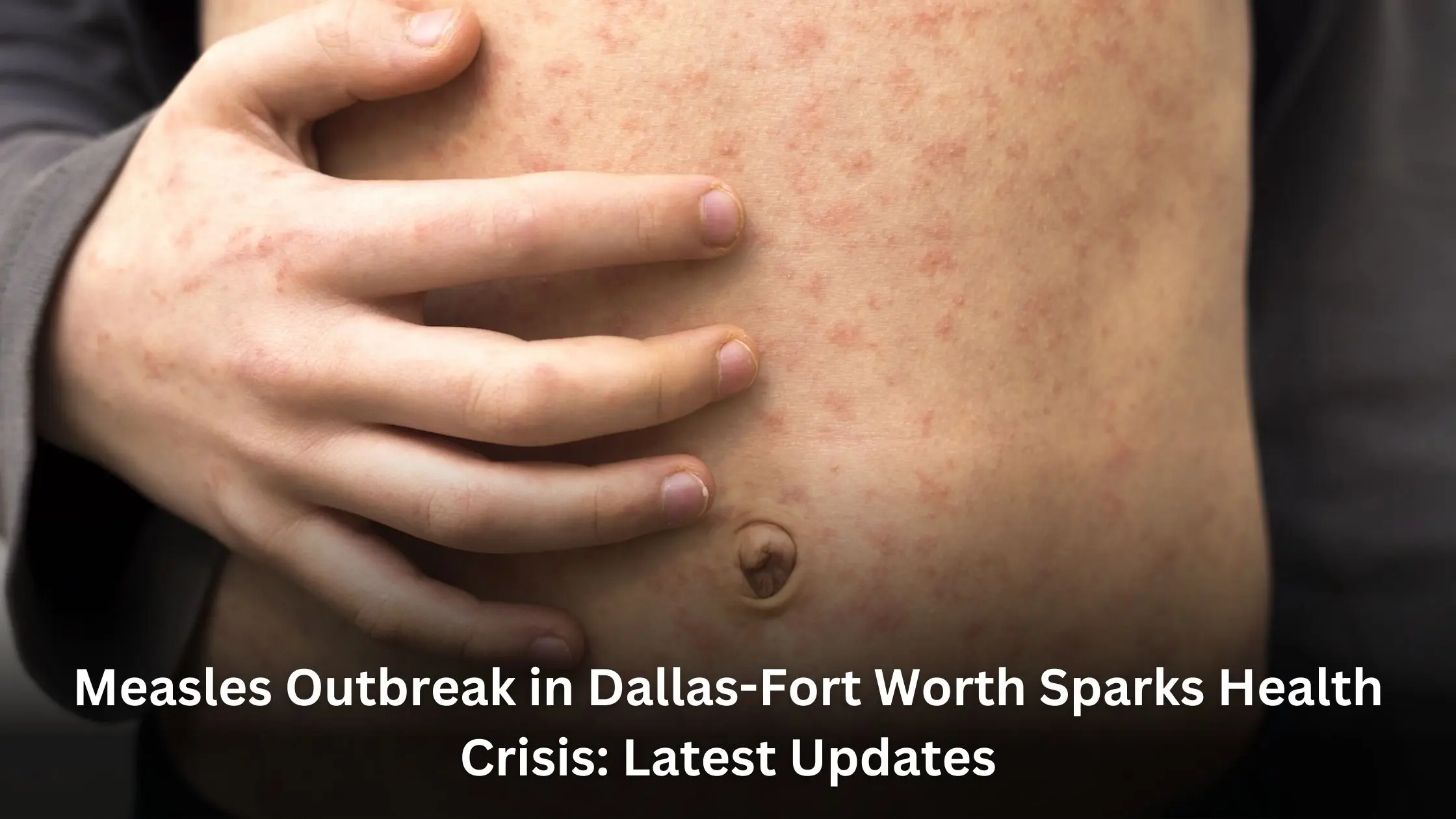 Measles Outbreak in Dallas-Fort Worth Sparks National Concern